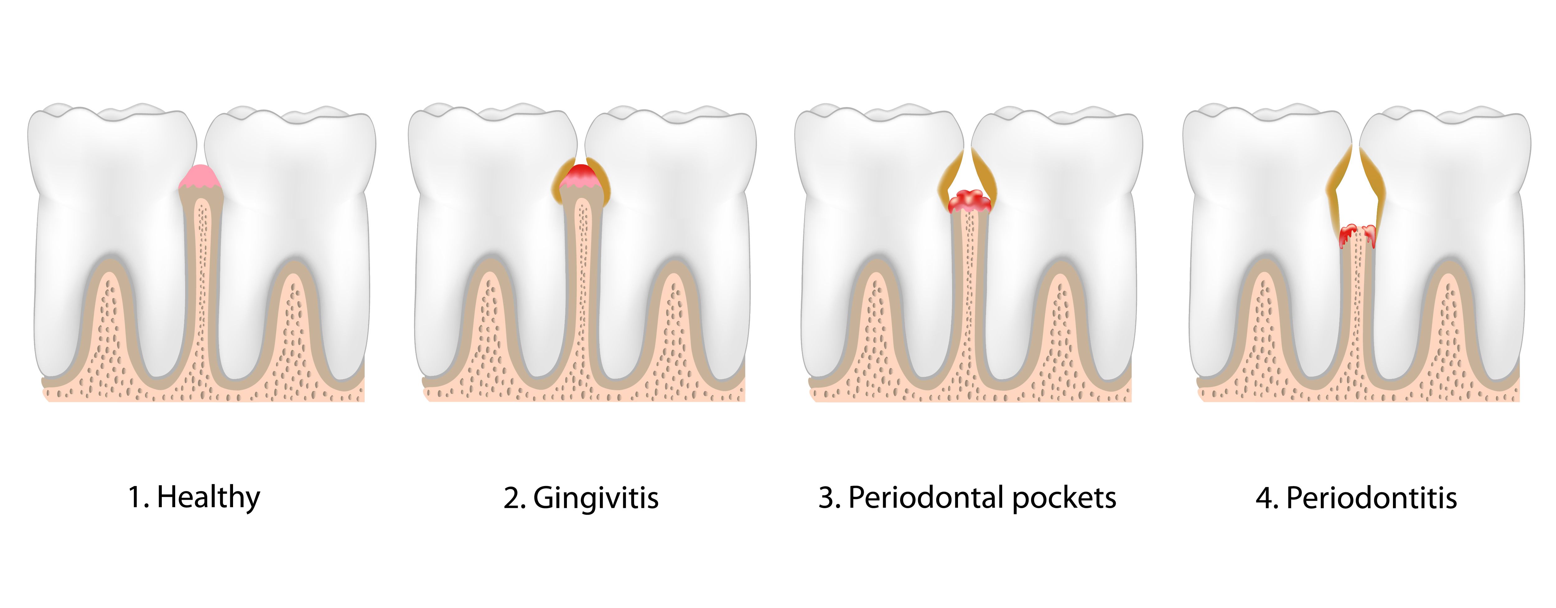 Illustration of stages of gum disease