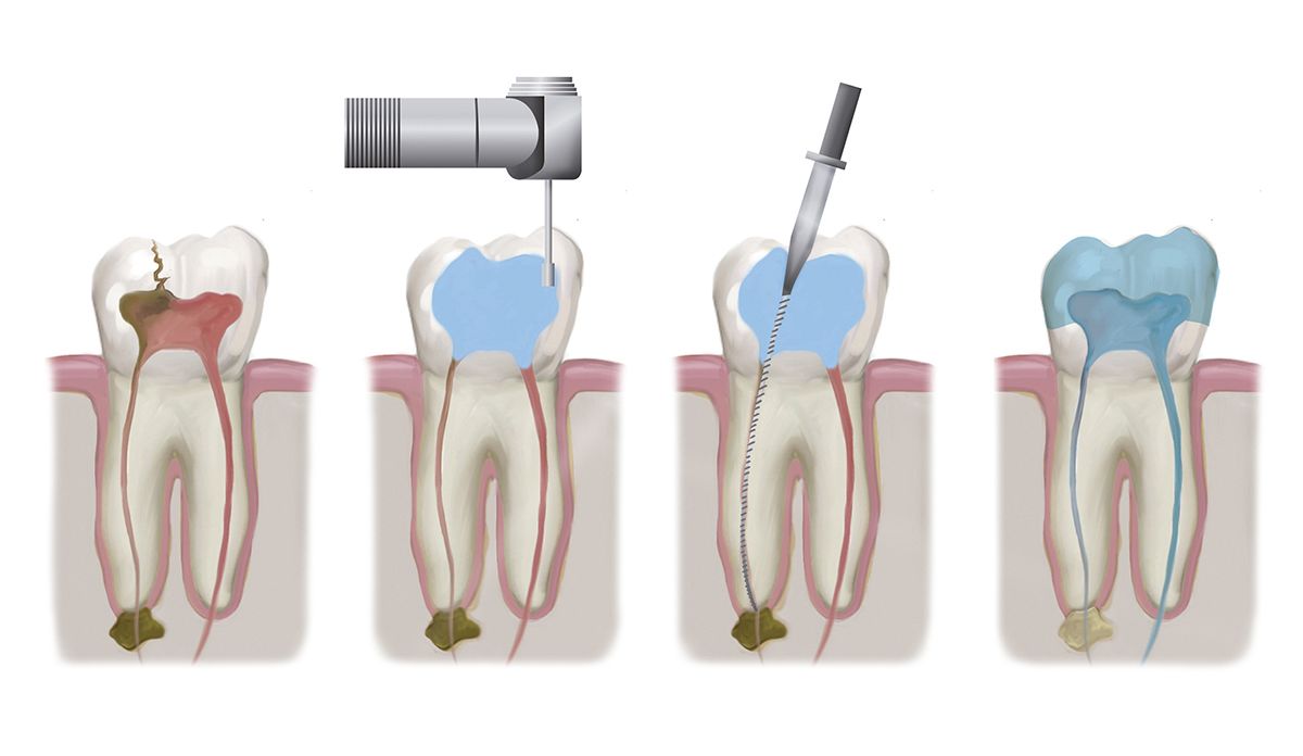 Illustration of a root canal therapy procedure