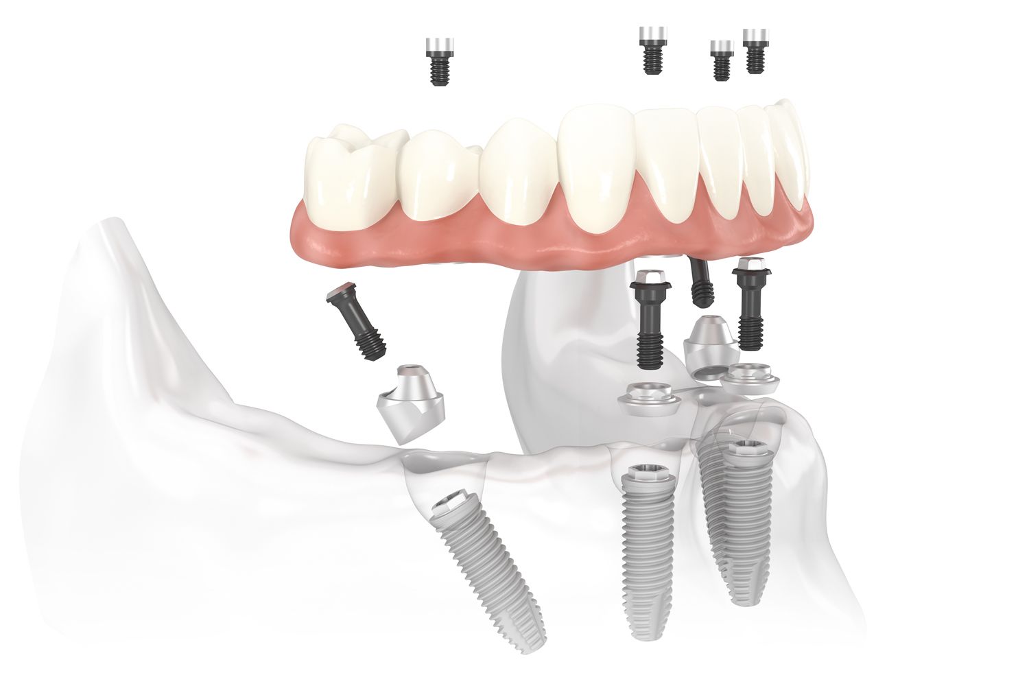 iimplant-supported dentures