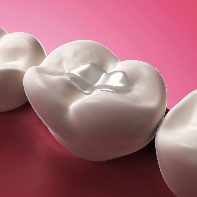 Illustration of a tooth-colored filling